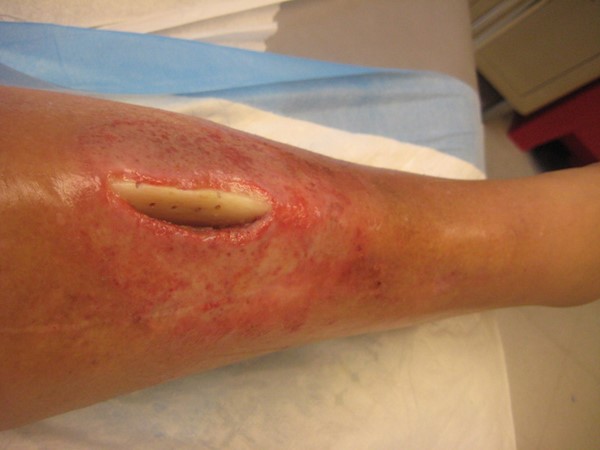 Ulcer with exposed bone