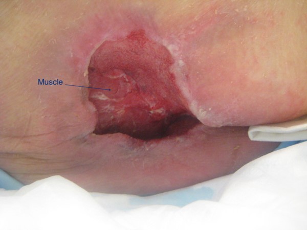 Wound bed with exposed muscle.