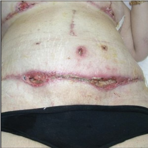 Surgical wound dehiscence