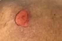 Stage 2 pressure ulcer/injury