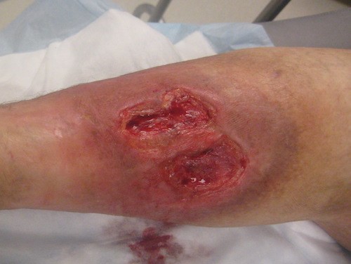 Venous leg ulcer post debridement