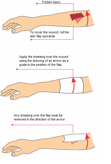 Dressing application on a skin tear
