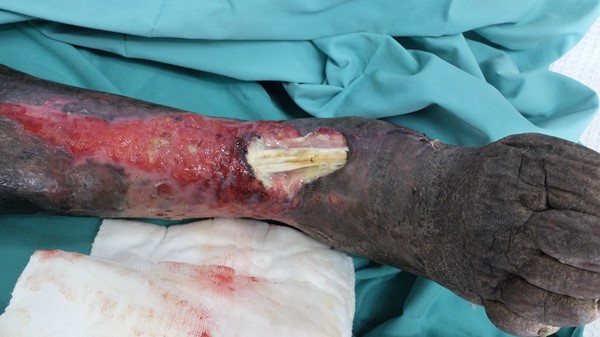 Venous leg ulcer with exposed tendon