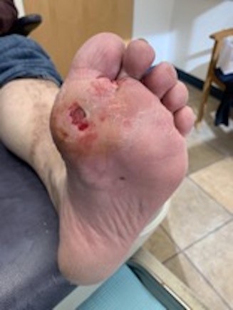 Metatarsal head ulcer