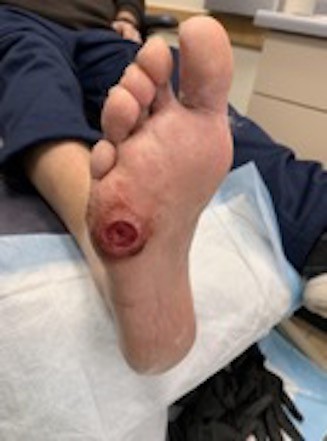 Firth metatarsal base ulcer
