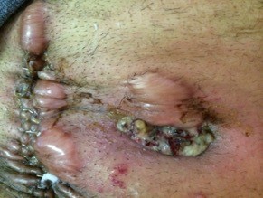 Necrotic, retracted end colostomy (post multiple revisions and relocations)