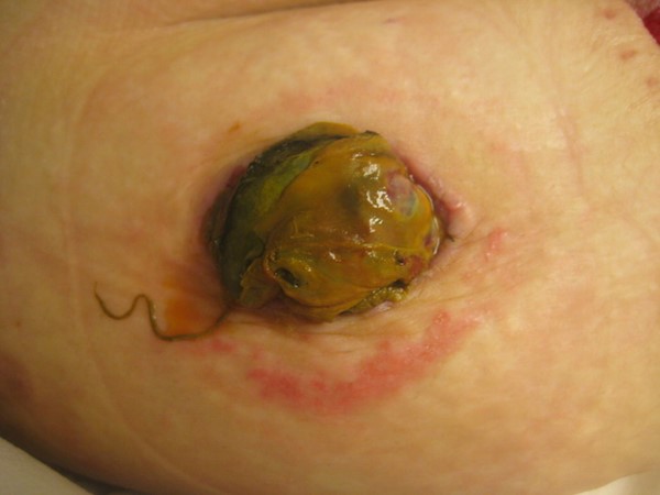 Necrotic loop ileostomy (by Lebedinskaya N)