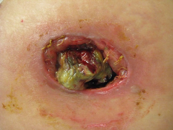 Necrotic, retracted stoma with visible mucocutaneous separation (by Lebedinskaya N)