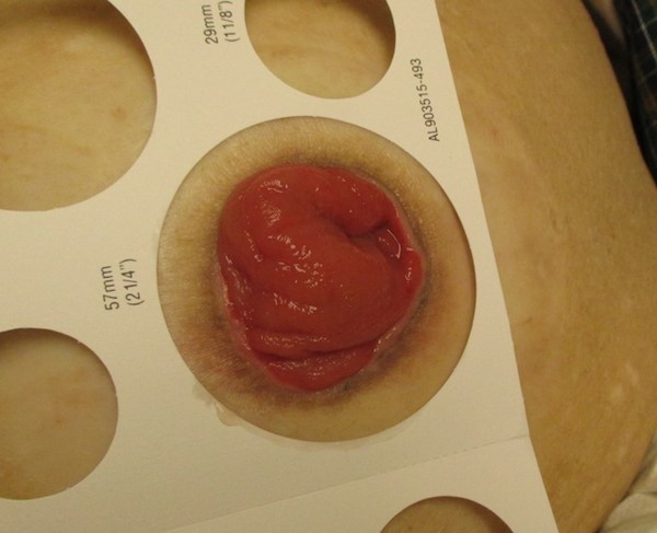 End stoma prolapse (by Lebedinskaya N)