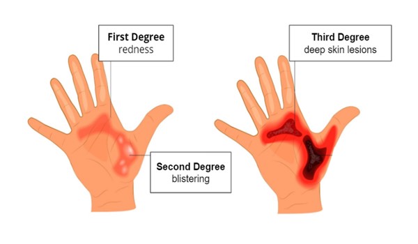 Classification of burn injury