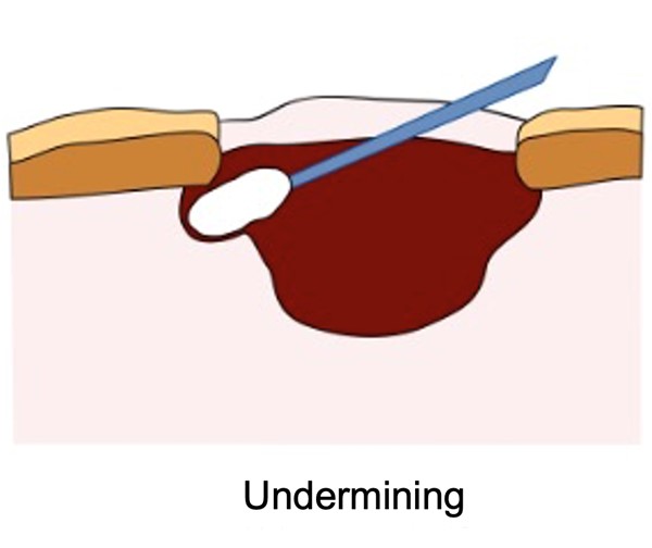 Measuring undermining