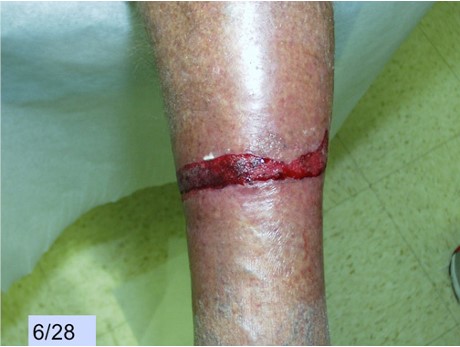 Non-epithelialized wound 