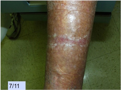 Newly epithelialized 