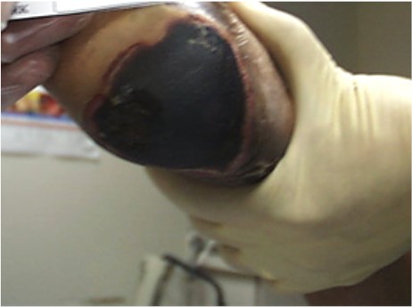 Eschar: firmly adherent, hard