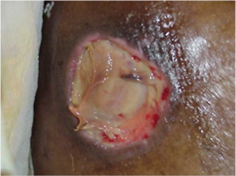 Slough: moist, adherent