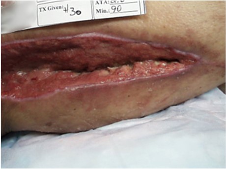 Clean, but non-granulating, dusky, pale wound