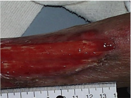 Clean, but non-granulating friable wound