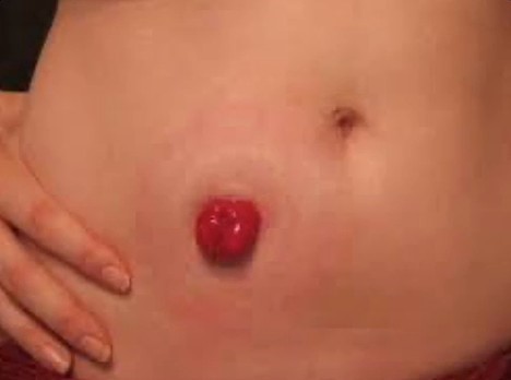 Healthy Stoma