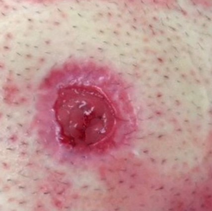 Dermatitis of the skin surrounding the stoma