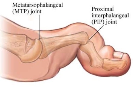 Hammer toe (distal phalangeal extension)