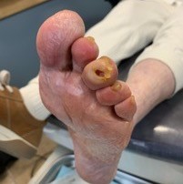 Diabetic foot ulcer at the tip of the left third toe