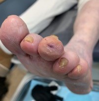 DFU, eleven days after surgical offloading