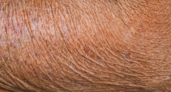 Aging Skin