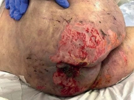 Association of IAD and Unstageable Pressure Injury