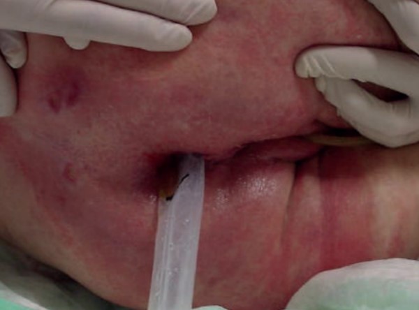Figure 3. Case 2. First day of placement of urinary and fecal diversion catheters. 