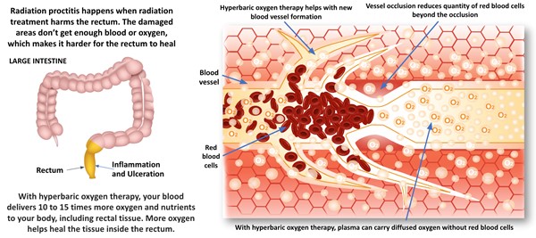 Effects of hyperbaric oxygen therapy on soft tissue radiation injury: proctitis 
