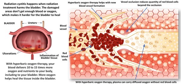 Effects of hyperbaric oxygen therapy on radiation cystitis