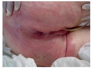IAD - Persistent redness without clinical signs of infection