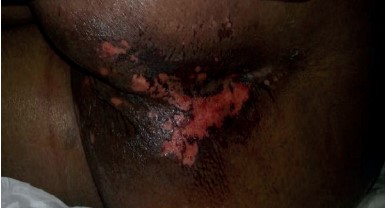 IAD - Skin loss without clinical signs of infection