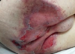 IAD - Skin loss with clinical signs of infection