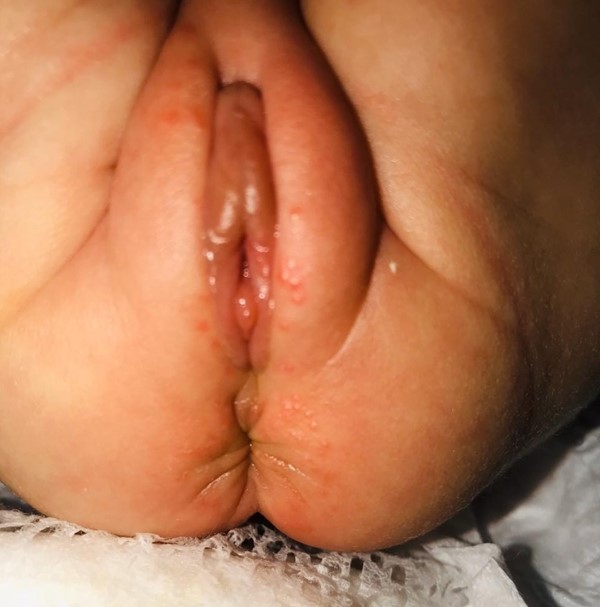Preterm newborn with IAD in the genital region showing signs of infection