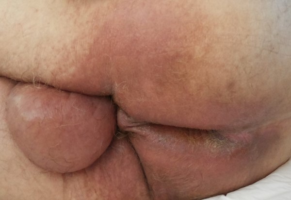Skin with erythema in the perineal and gluteal region.