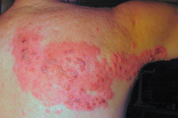 Herpes zoster, Fisle, CC BY-SA 3.0, via Wikimedia Commons