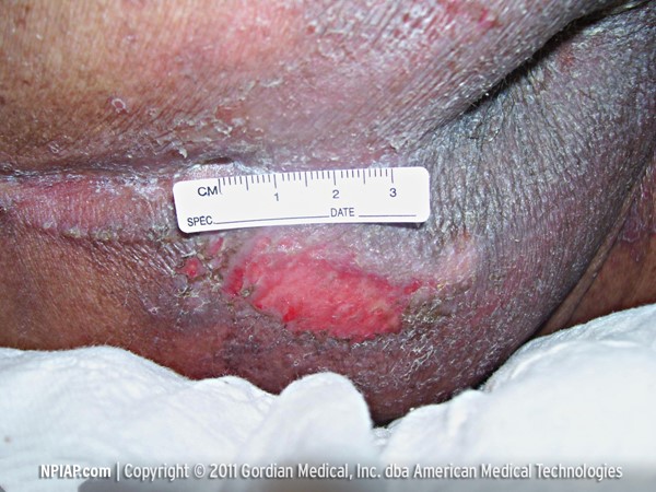 Stage 2 pressure ulcer/injury, with permission from the NPIAP