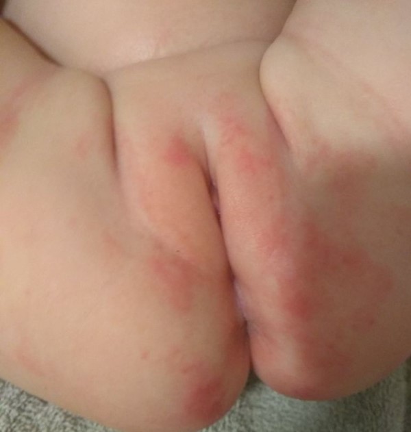 Incontinence associated dermatitis with mild erythema and minimal irritation