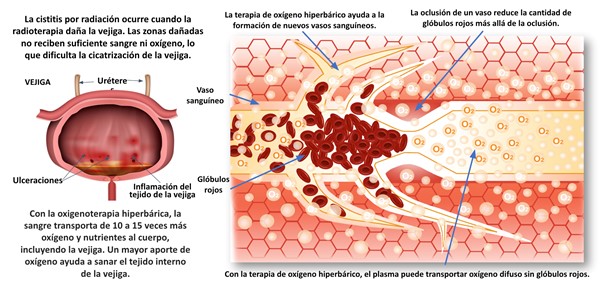 Efectos de la terapia de oxígeno hiperbárico en cistitis por radiación