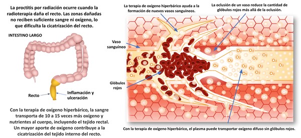 fectos de la terapia de oxígeno hiperbárico en proctitis por radiación
