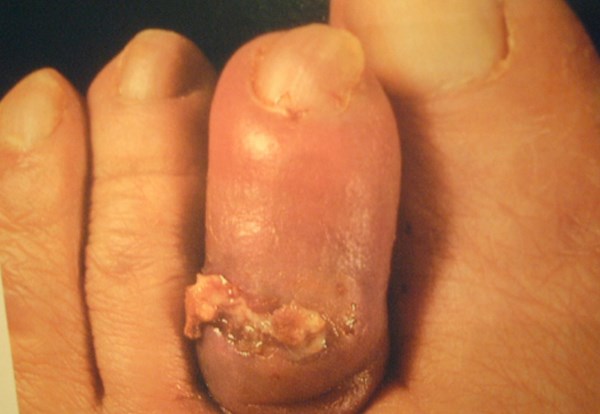 Sausage toe suggestive of osteomyelitis