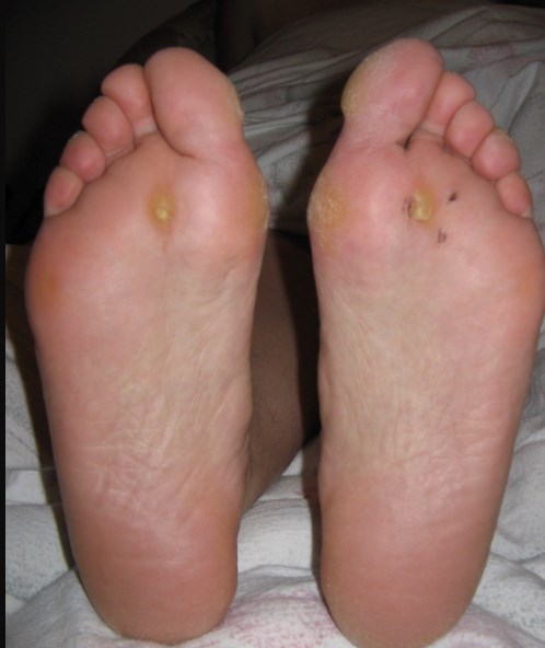 Plantar wards and scars. By Marionette, http://www.gnu.org/copyleft/fdl.html