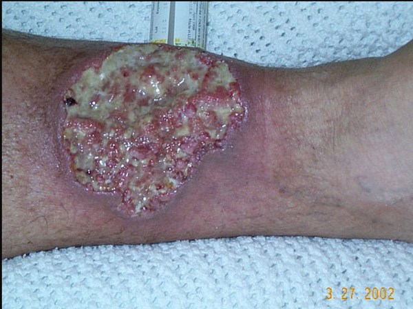 Pyoderma gangrenosum. By Crohnie