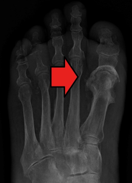 Osteomyelitis. By James Heilman, MD. https://creativecommons.org/licenses/by-sa/4.0